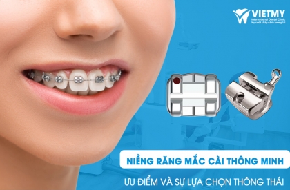 Niềng răng mắc cài thông minh: Ưu điểm và sự lựa chọn thông thái